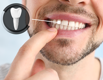 The image features a man with a toothpick in his mouth, examining his teeth in front of a magnified dental implant graphic on a monitor.