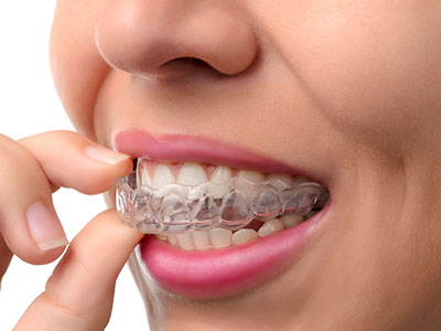 Woman with clear aligners, examining her teeth alignment.