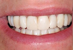 The image shows a close-up view of a person s teeth and smile.