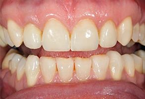 The image displays a close-up view of a person s teeth with a focus on yellowing and staining, showcasing dental discoloration without any text or additional elements visible.