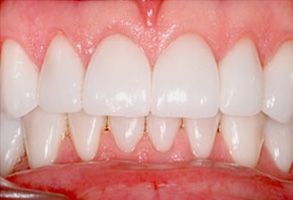 The image shows a close-up view of a person s teeth with a focus on a dental procedure, likely an orthodontic treatment, given the presence of braces and the alignment of the teeth.