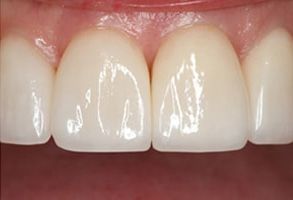 The image shows a close-up view of a person s teeth with a focus on a set of white veneers, highlighting their brightness and uniformity.