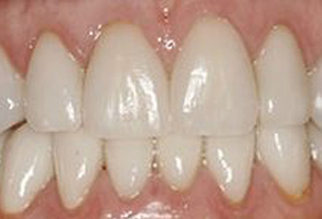 The image shows a close-up view of a person s teeth with a focus on a yellowish stained area, suggesting a need for dental care or cleaning.
