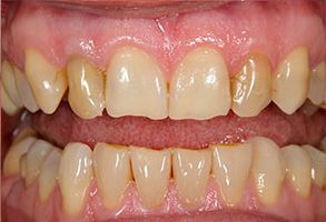 The image shows two close-up photographs of teeth with yellowish stains, set against a white background, possibly for dental care purposes.