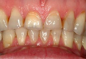 The image shows a close-up view of a person s mouth with yellowing teeth, some of which appear to be decayed or damaged, and gums that are reddened and inflamed.